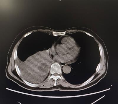 Individualized Treatment for Advanced Non-Small Cell Lung Cancer: A Case Report and Literature Review